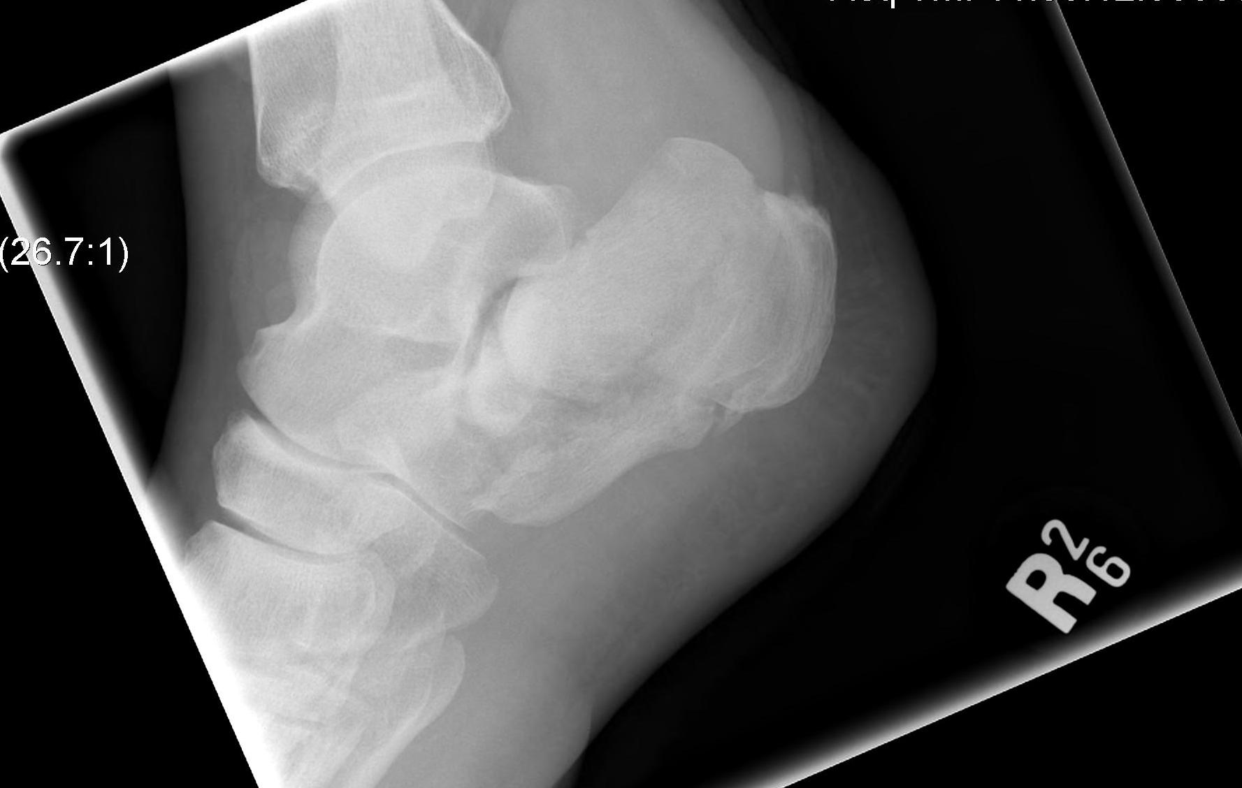 Calcaneal Fracture Intra-articular